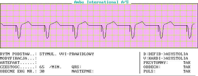 Wykresy EKG - c30-0.png